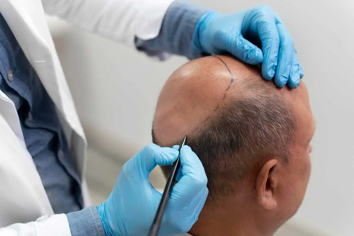 نمونه‌ای از روش کاشت مو FUE با استفاده از دستگاه‌های پیشرفته