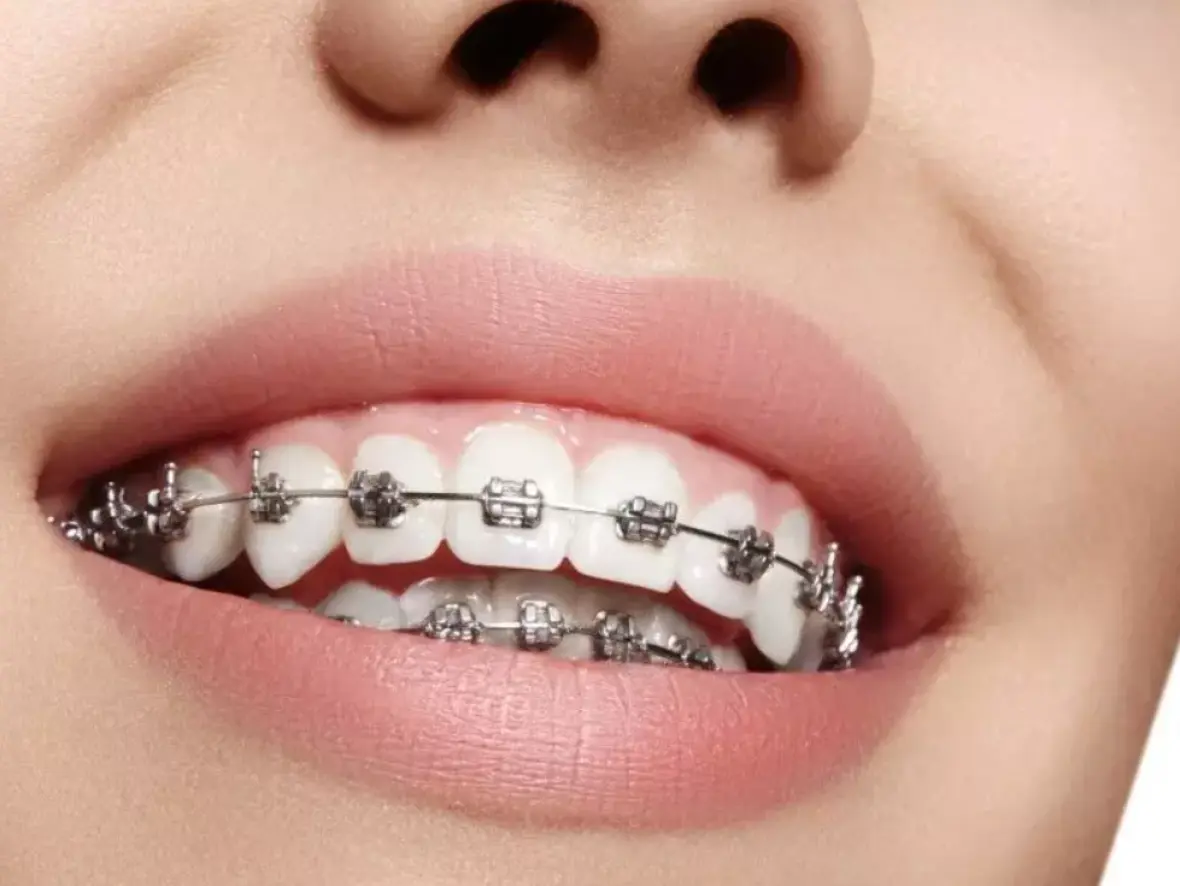 دندانپزشک در حال بررسی دندانهای بیمار با ابزارهای ارتودنسی