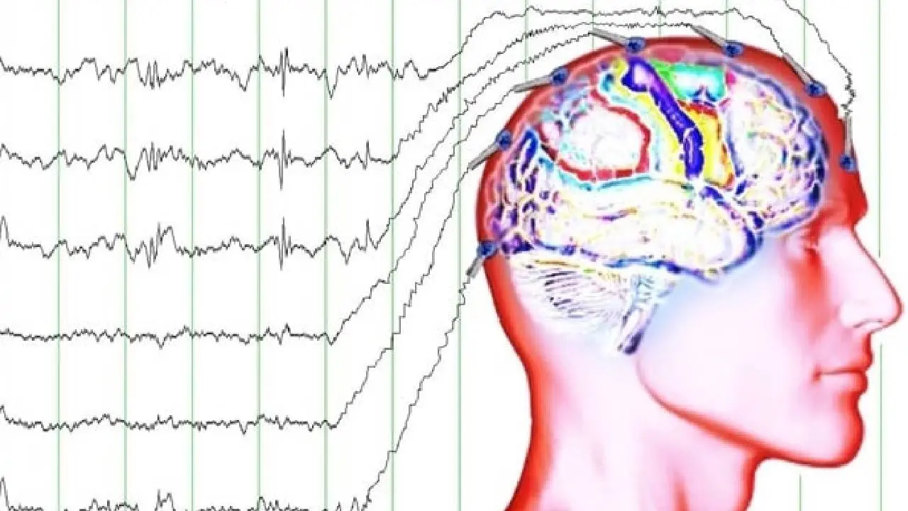 الکترودهای EEG روی سر یک فرد برای ثبت فعالیت الکتریکی مغز