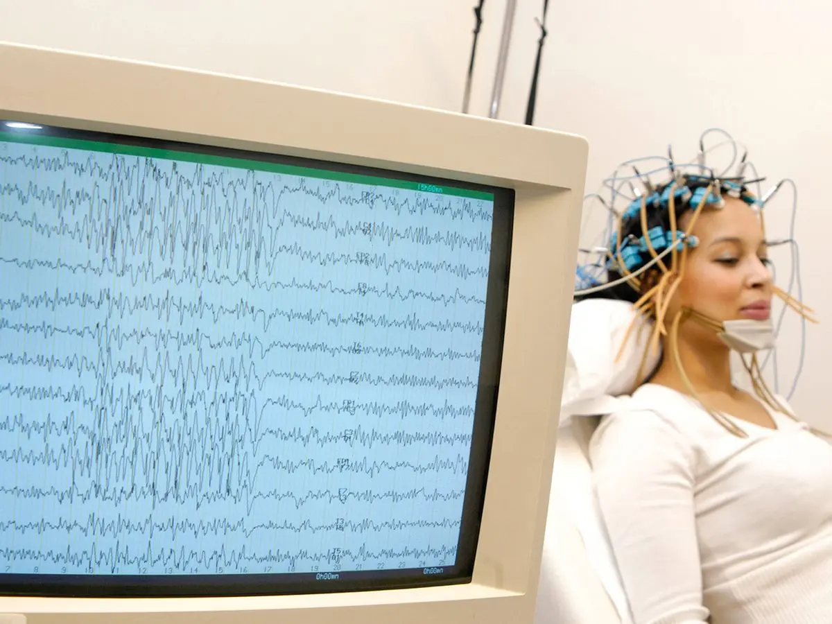نمایشگر دستگاه EEG با ثبت امواج مغزی یک بیمار مبتلا به اپیلپسی