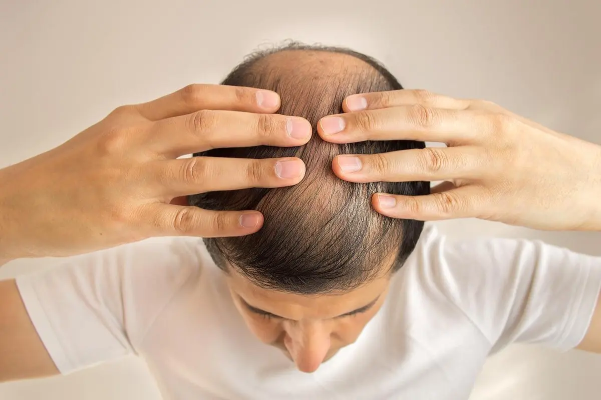مردی که به دلیل ریزش مو دچار استرس شده است