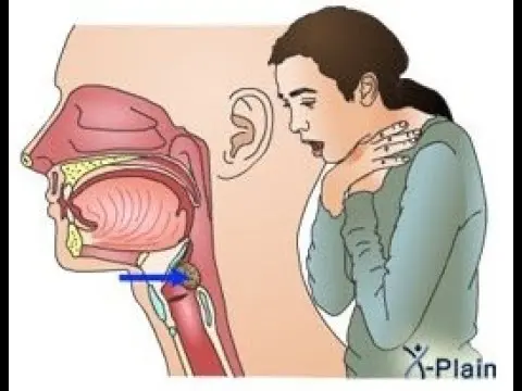 آموزش ضربات بین شانه برای کمک به فرد خفگی