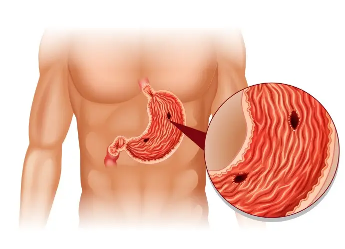 نمودار تشریحی زخم معده و ساختار آناتومیک آن