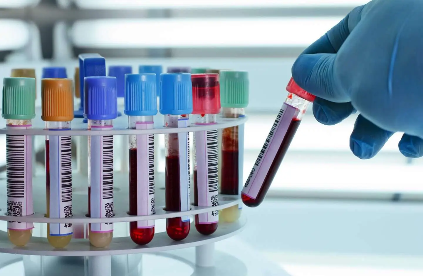 نمونه آزمایش خون برای اندازهگیری HbA1c
