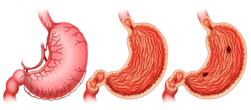 زخم معده چیست و چه علائمی دارد؛ نکات مهم و کاربردی