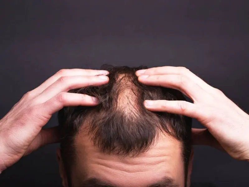 چه زمانی ریزش مو نیاز به بررسی پزشکی دارد؛ راهنمای ساده برای شروع